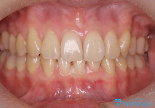 前歯のがたつき、八重歯　インビザラインで抜歯矯正の症例 治療後