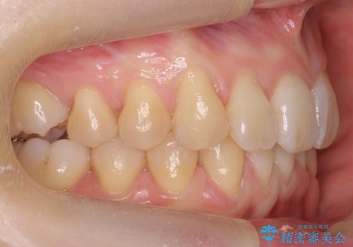 前歯のがたつき、八重歯　インビザラインで抜歯矯正の治療後
