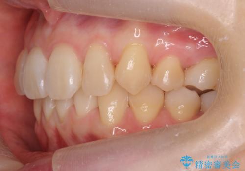 前歯のがたつき、八重歯　インビザラインで抜歯矯正の治療後