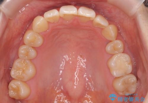 前歯のがたつき、八重歯 インビザラインで抜歯矯正の治療後