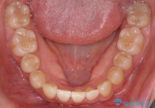 前歯のがたつき、八重歯 インビザラインで抜歯矯正の治療後