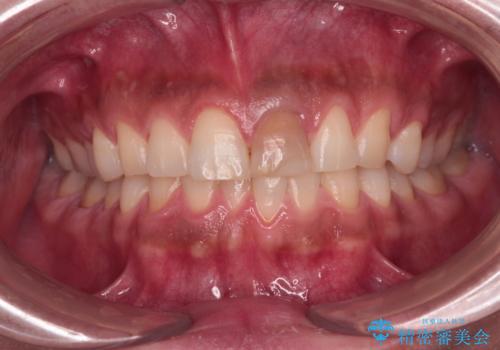 変色した前歯をオールセラミッククラウンにの治療前