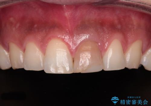 変色した前歯をオールセラミッククラウンにの治療前