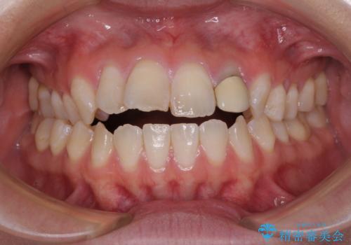 開咬を治す インビザラインによる矯正治療の症例 治療前