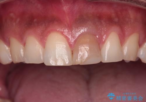 変色した前歯をオールセラミッククラウンにの治療前