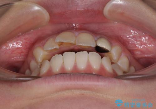 開咬を治す インビザラインによる矯正治療の治療前