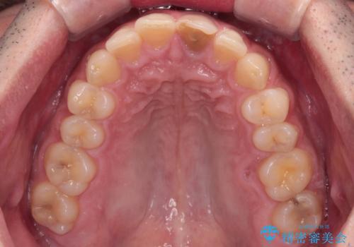 変色した前歯をオールセラミッククラウンにの治療前