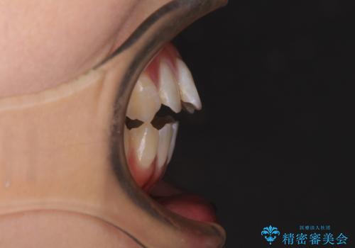 開咬を治す インビザラインによる矯正治療の治療前