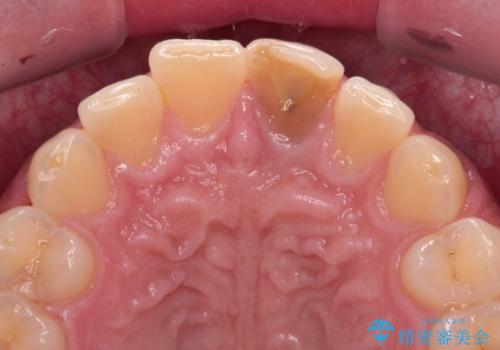 変色した前歯をオールセラミッククラウンにの治療前