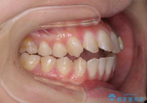 開咬を治す インビザラインによる矯正治療の治療前