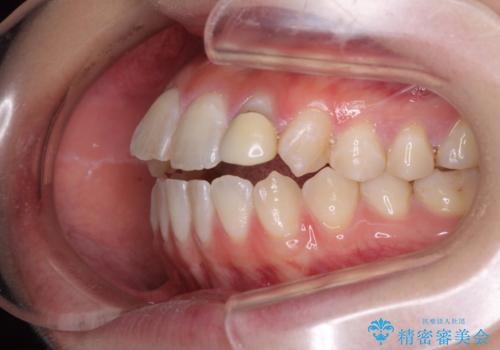 開咬を治す インビザラインによる矯正治療の治療前