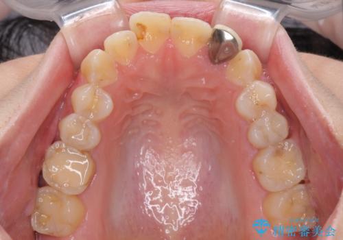 開咬を治す インビザラインによる矯正治療の治療前