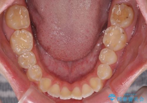 開咬を治す インビザラインによる矯正治療の治療前