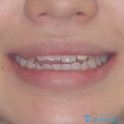 開咬を治す インビザラインによる矯正治療の治療前(顔貌)