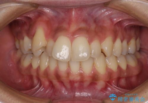 八重歯と出っ歯を治したい　ワイヤー装置での抜歯矯正の症例 治療前
