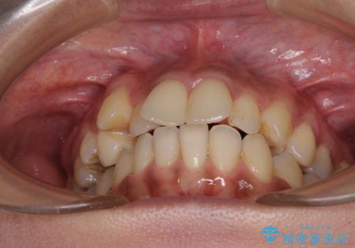 八重歯と出っ歯を治したい ワイヤー装置での抜歯矯正の治療前