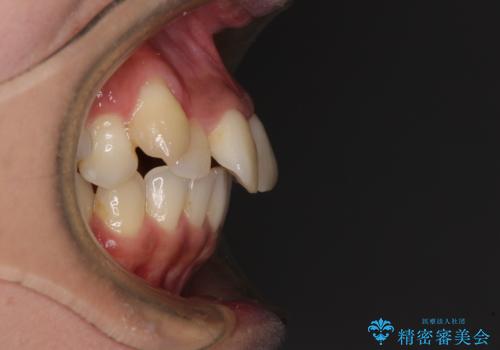 八重歯と出っ歯を治したい ワイヤー装置での抜歯矯正の治療前