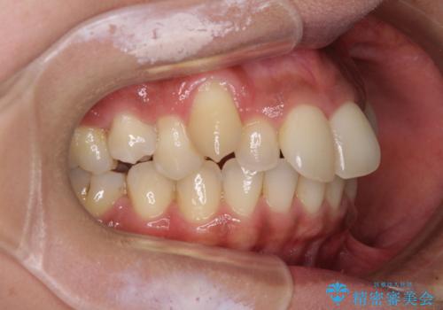 八重歯と出っ歯を治したい ワイヤー装置での抜歯矯正の治療前