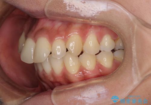 八重歯と出っ歯を治したい ワイヤー装置での抜歯矯正の治療前