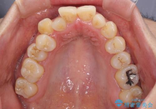 八重歯と出っ歯を治したい　ワイヤー装置での抜歯矯正の治療前