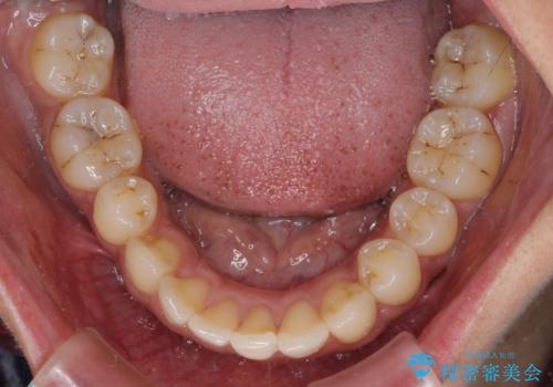 八重歯と出っ歯を治したい ワイヤー装置での抜歯矯正の治療前