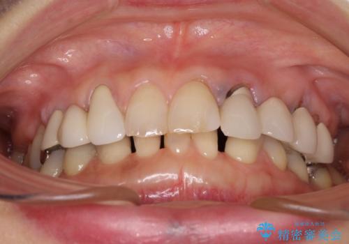 割れてしまった歯が痛む　矯正とインプラントを併用した総合歯科治療の治療前