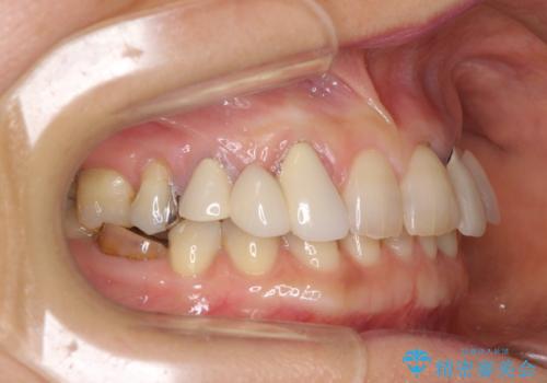 割れてしまった歯が痛む 矯正とインプラントを併用した総合歯科治療の治療前
