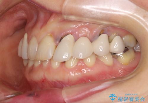 割れてしまった歯が痛む 矯正とインプラントを併用した総合歯科治療の治療前