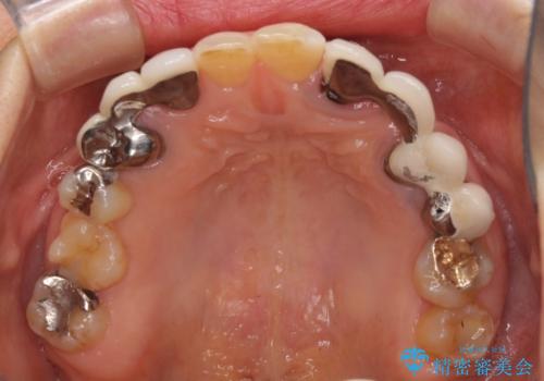 割れてしまった歯が痛む 矯正とインプラントを併用した総合歯科治療の治療前