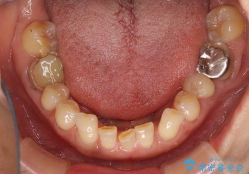 割れてしまった歯が痛む 矯正とインプラントを併用した総合歯科治療の治療前