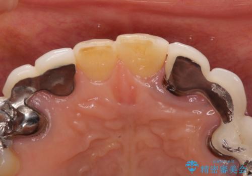 割れてしまった歯が痛む 矯正とインプラントを併用した総合歯科治療の治療前