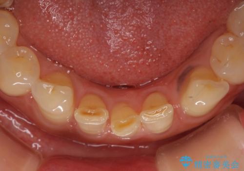 割れてしまった歯が痛む 矯正とインプラントを併用した総合歯科治療の治療前