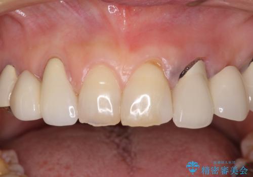 割れてしまった歯が痛む 矯正とインプラントを併用した総合歯科治療の治療前