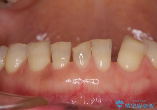 割れてしまった歯が痛む 矯正とインプラントを併用した総合歯科治療の治療前