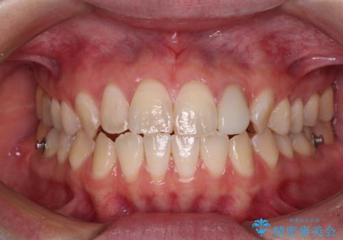 開咬を治す インビザラインによる矯正治療の治療中