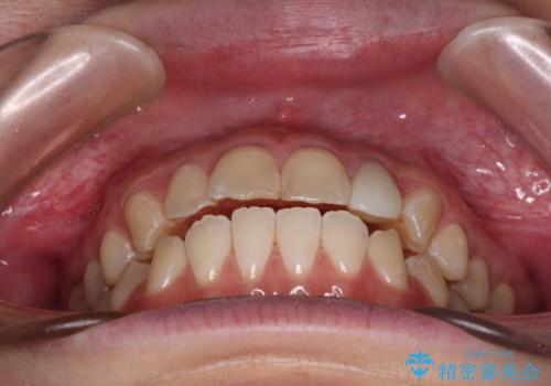 開咬を治す インビザラインによる矯正治療の治療中