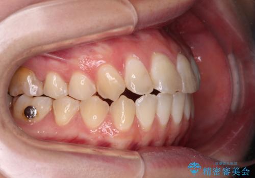 開咬を治す インビザラインによる矯正治療の治療中