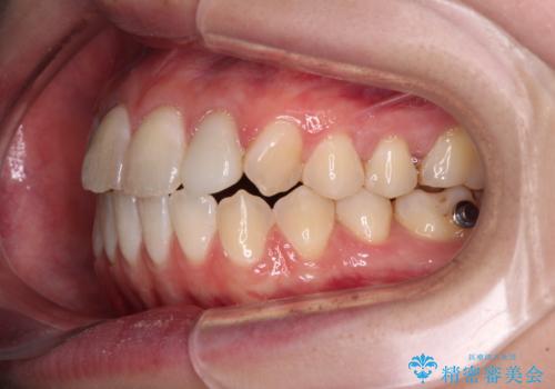 開咬を治す インビザラインによる矯正治療の治療中
