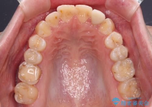 開咬を治す インビザラインによる矯正治療の治療中