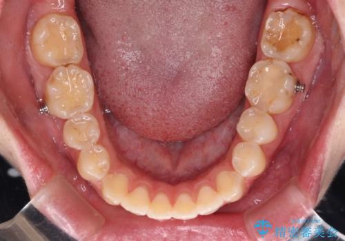 開咬を治す インビザラインによる矯正治療の治療中