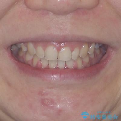 隙間の空いた歯列とボロボロの乳歯　インプラント治療と矯正治療の治療後（顔貌）