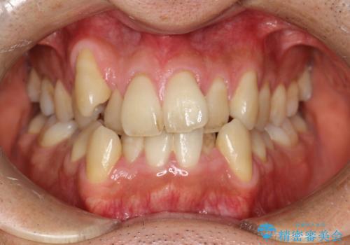 ガタガタの歯並び、八重歯をなおしたい、骨格性下顎前突　カモフラージュ矯正の症例 治療前
