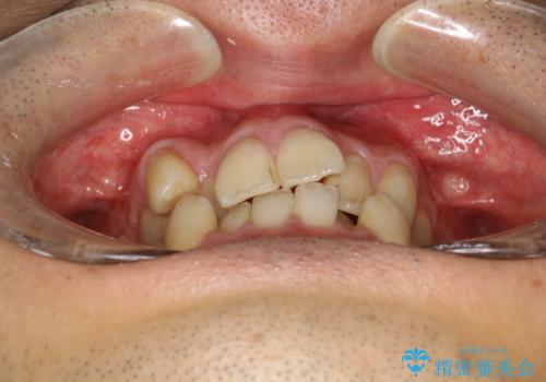 ガタガタの歯並び、八重歯をなおしたい、骨格性下顎前突 カモフラージュ矯正の治療前