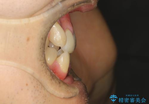 ガタガタの歯並び、八重歯をなおしたい、骨格性下顎前突 カモフラージュ矯正の治療前