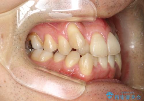 ガタガタの歯並び、八重歯をなおしたい、骨格性下顎前突　カモフラージュ矯正の治療前