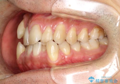 ガタガタの歯並び、八重歯をなおしたい、骨格性下顎前突 カモフラージュ矯正の治療前