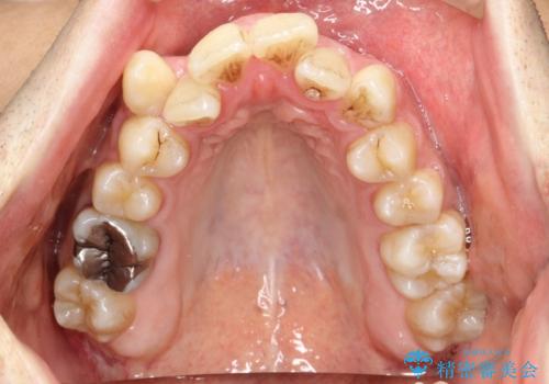 ガタガタの歯並び、八重歯をなおしたい、骨格性下顎前突 カモフラージュ矯正の治療前