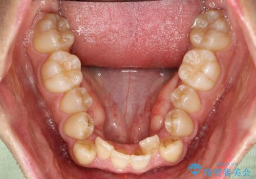 ガタガタの歯並び、八重歯をなおしたい、骨格性下顎前突 カモフラージュ矯正の治療前