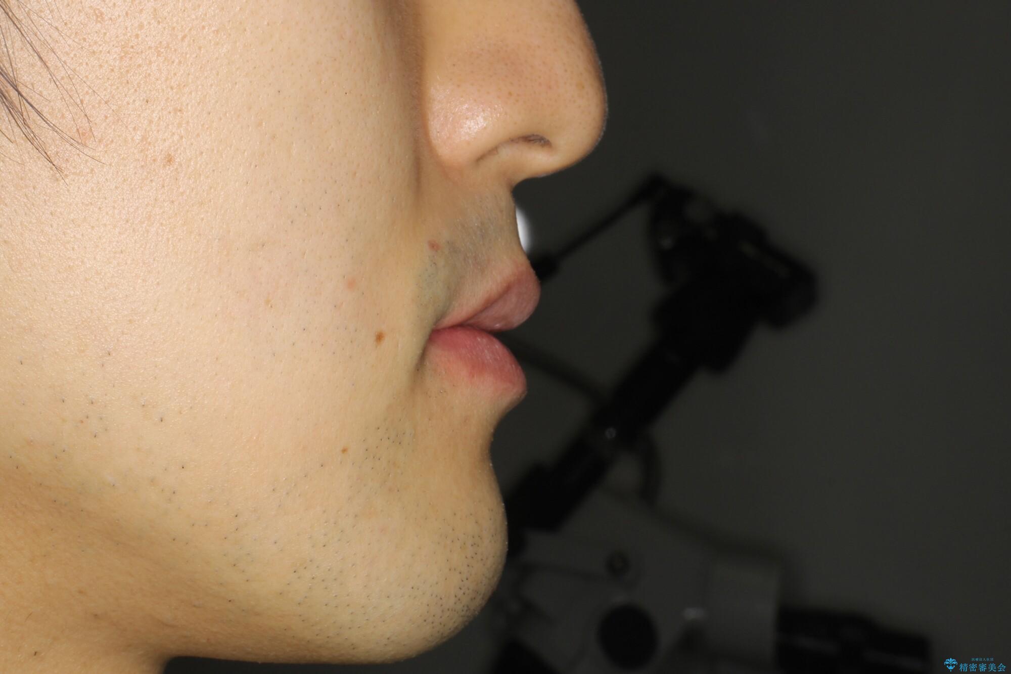 ガタガタの歯並び、八重歯をなおしたい、骨格性下顎前突 カモフラージュ矯正の治療前(顔貌)