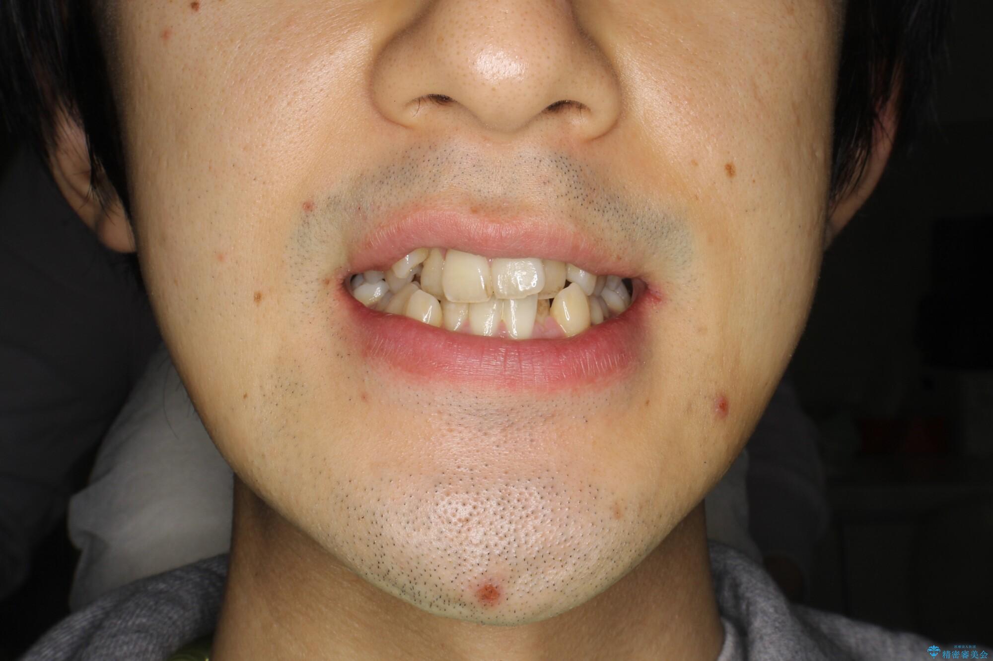 ガタガタの歯並び、八重歯をなおしたい、骨格性下顎前突　カモフラージュ矯正の治療前（顔貌）